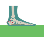 PLANTAR FASCIITIS